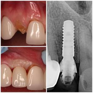 dental implant before and after case study