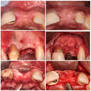 case study of dental implants