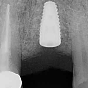 x-ray of a dental implant
